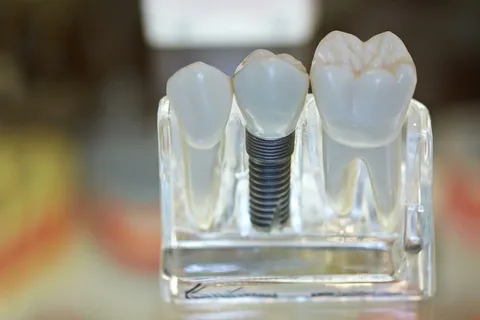 dental implant treatment in aurangabad